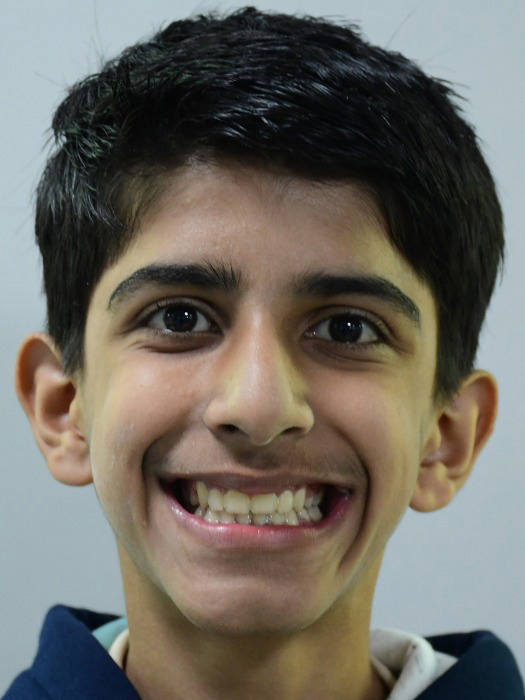 Children's Orthodontics - after