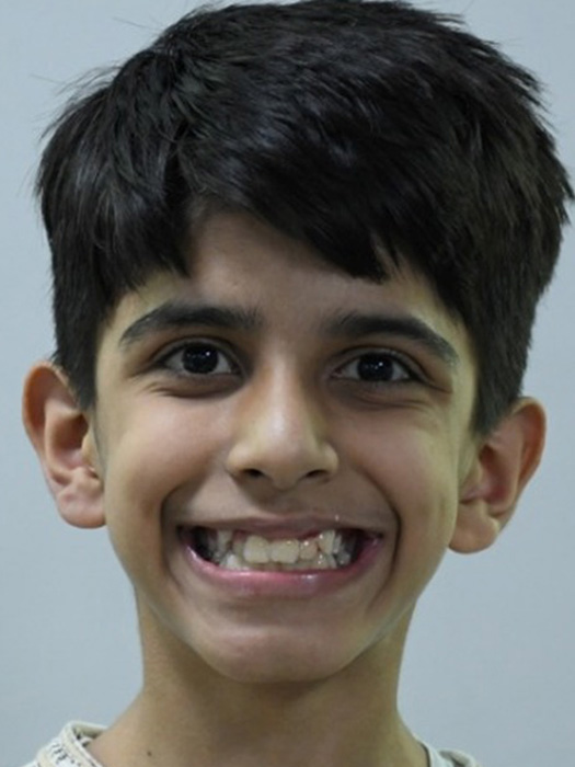 Children's Orthodontics - before
