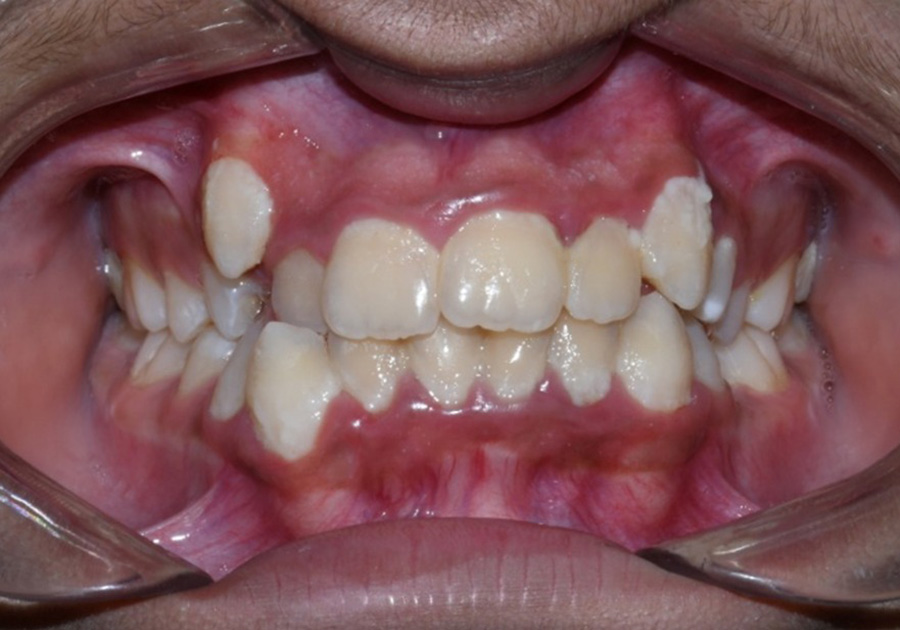 Children's Orthodontics - before