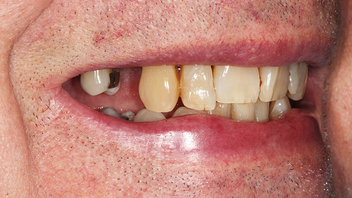 Implant to replace the upper left central incisor - before