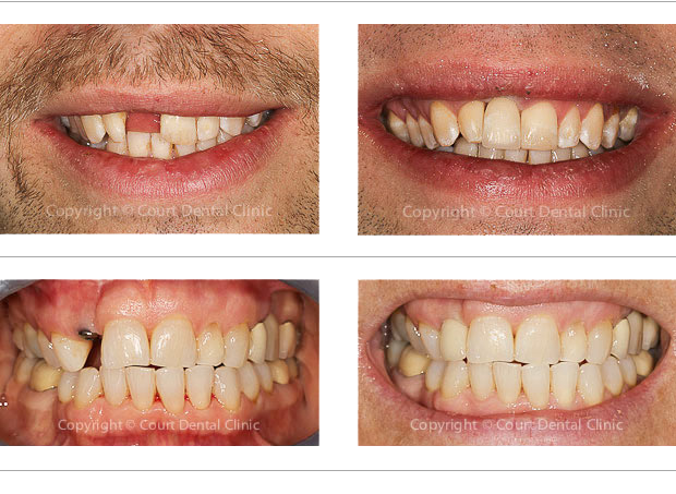 Dental implants - before and after treatment