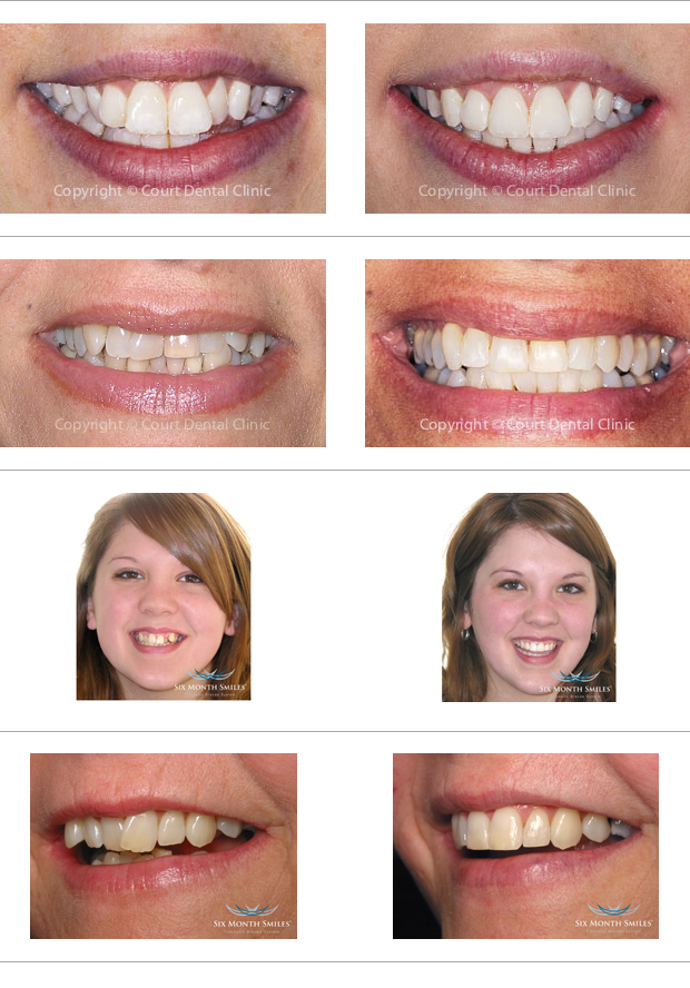Six Month Smiles - Clear Braces at Court Dental Surgery Beaconsfield Buckinghamshire